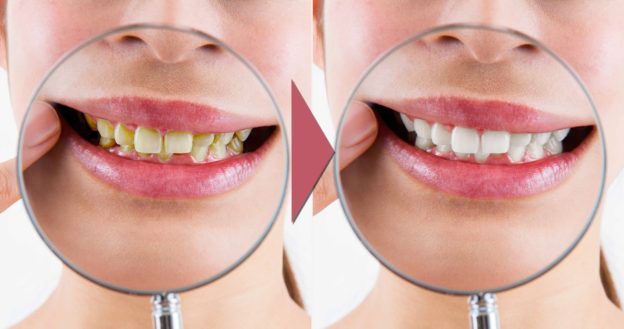 ホワイトニング前とホワイトニング後の歯の色の比較