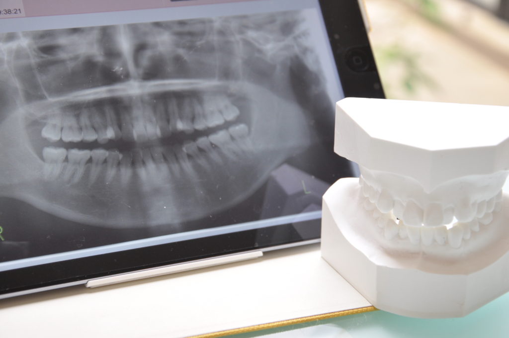 歯のレントゲン写真が写ったパソコンの前に歯の模型